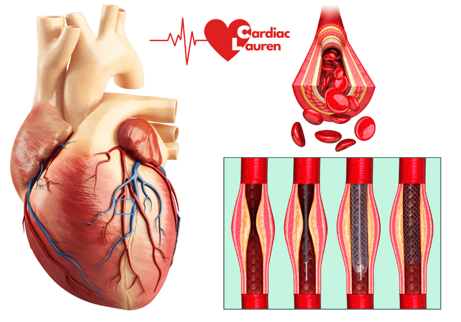 Heart, blood flow through a healthy artery,, blocked artery, angiogram, angioplasty stent pci