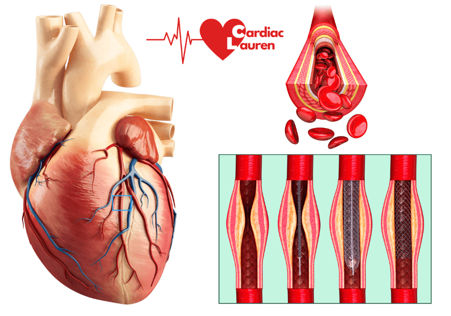 What to expect after having a mild heart attack 4 Heart, blood flow through a healthy artery,, blocked artery, angiogram, Angioplasty Stent PCI
